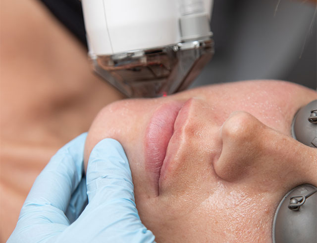 Halo-820 Woman receiving a laser hair removal treatments at a med spa