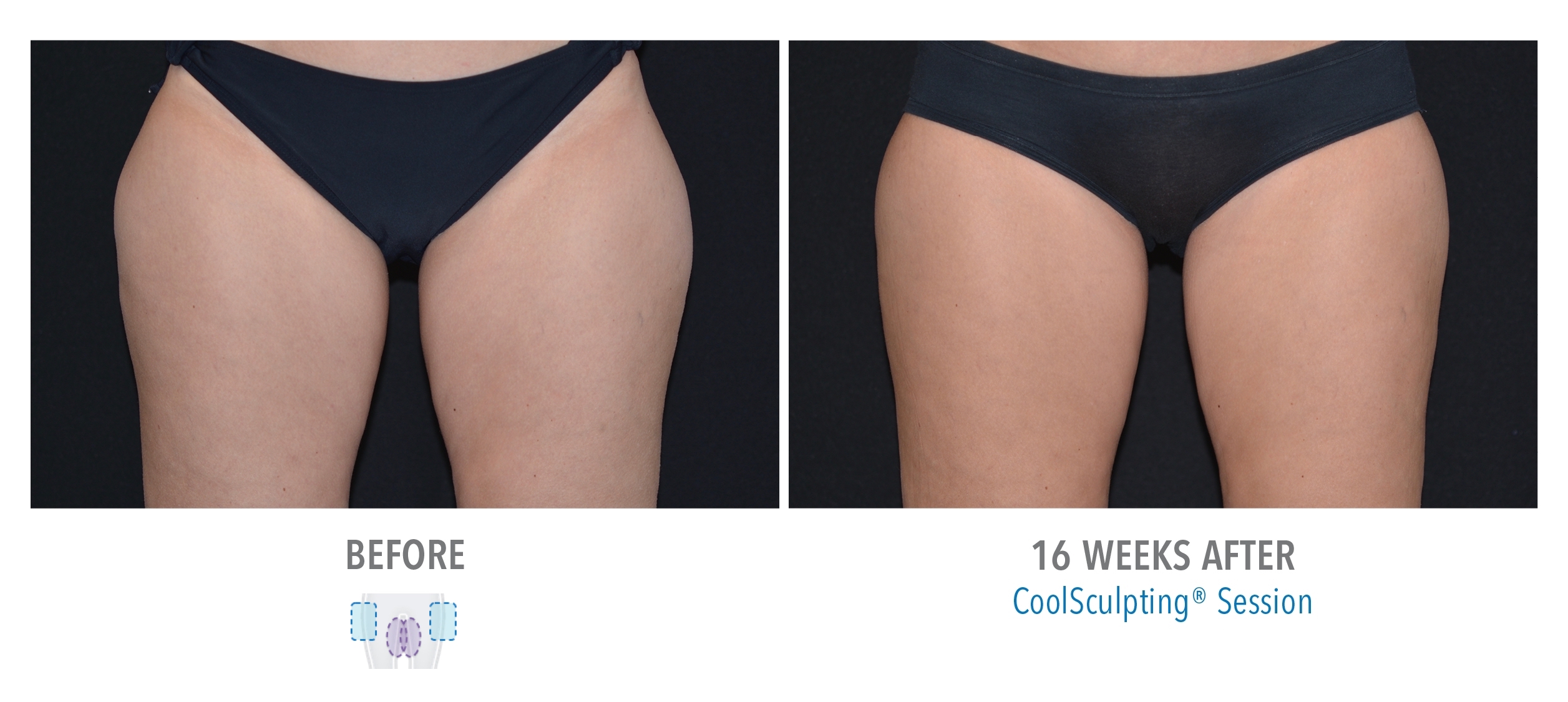 woman receiving coolsculpting