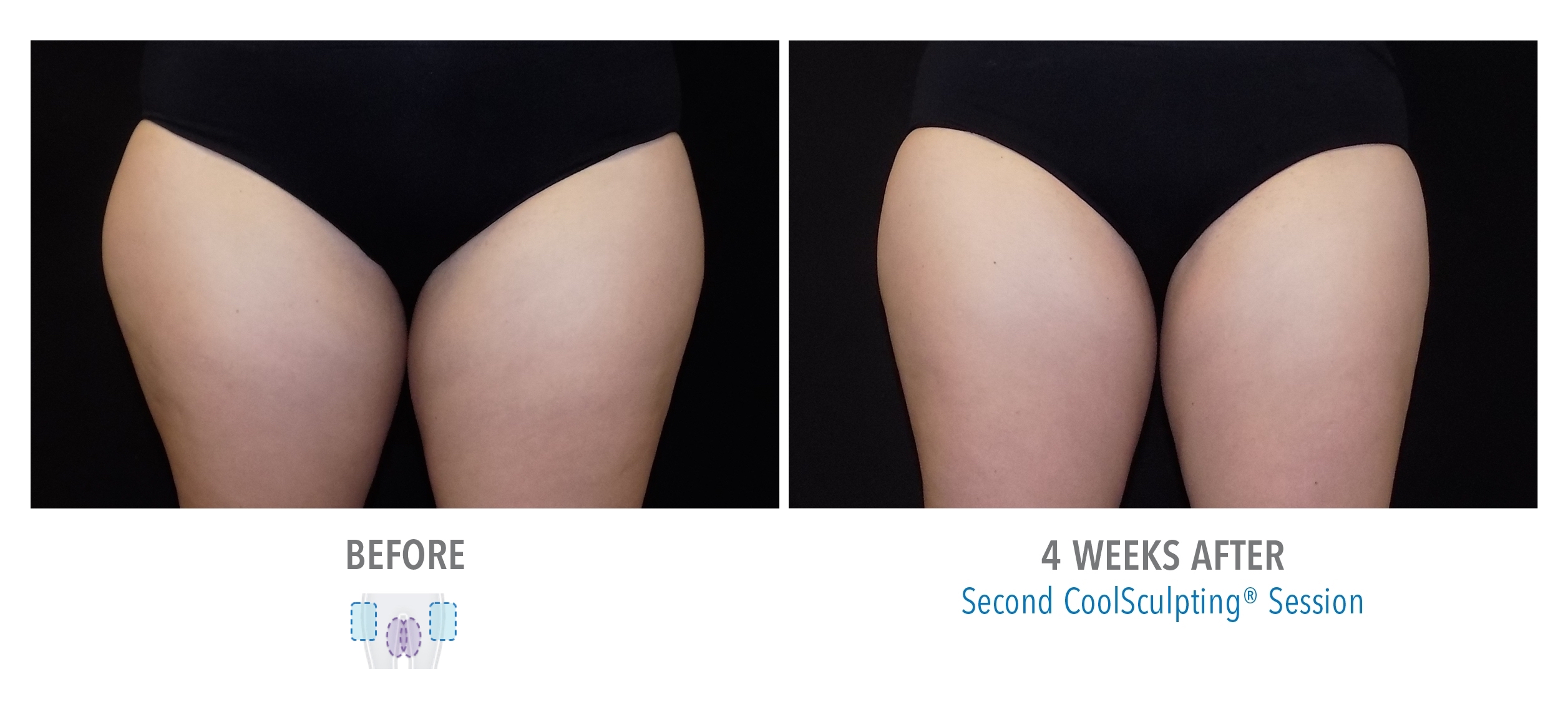 woman receiving coolsculpting