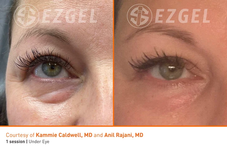 EZ Gel PRF Vitalyc Medspa Dallas TX before-and-after-2