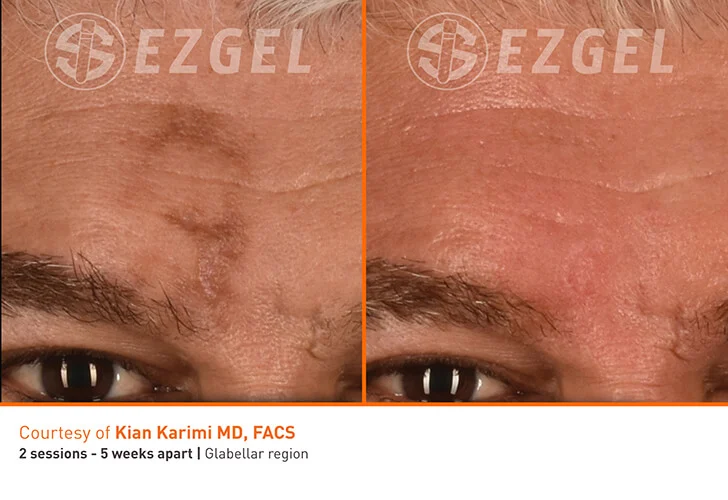 EZ Gel PRF Vitalyc Medspa Dallas TX before-and-after-3