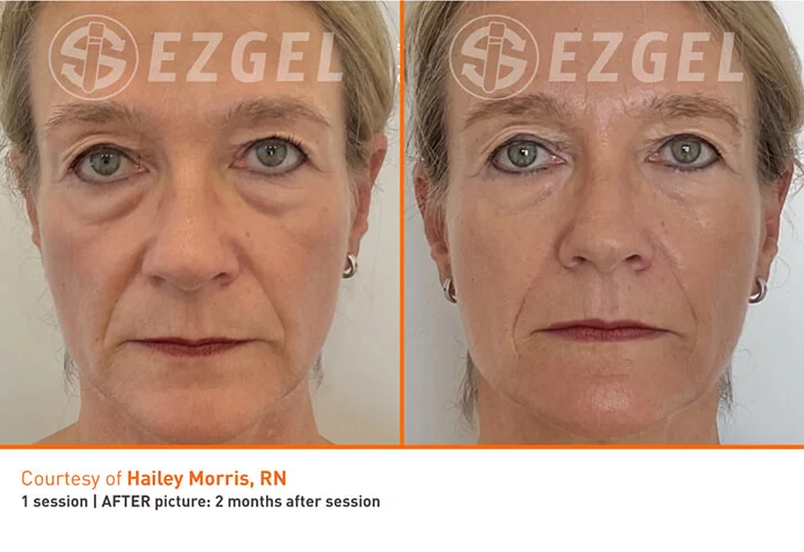 EZ Gel PRF Vitalyc Medspa Dallas TX before-and-after-4