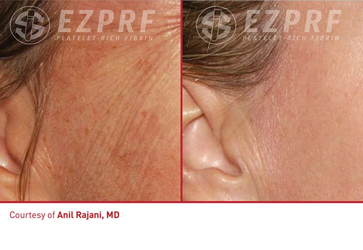 EZ Gel PRF Vitalyc Medspa Dallas TX before-and-after